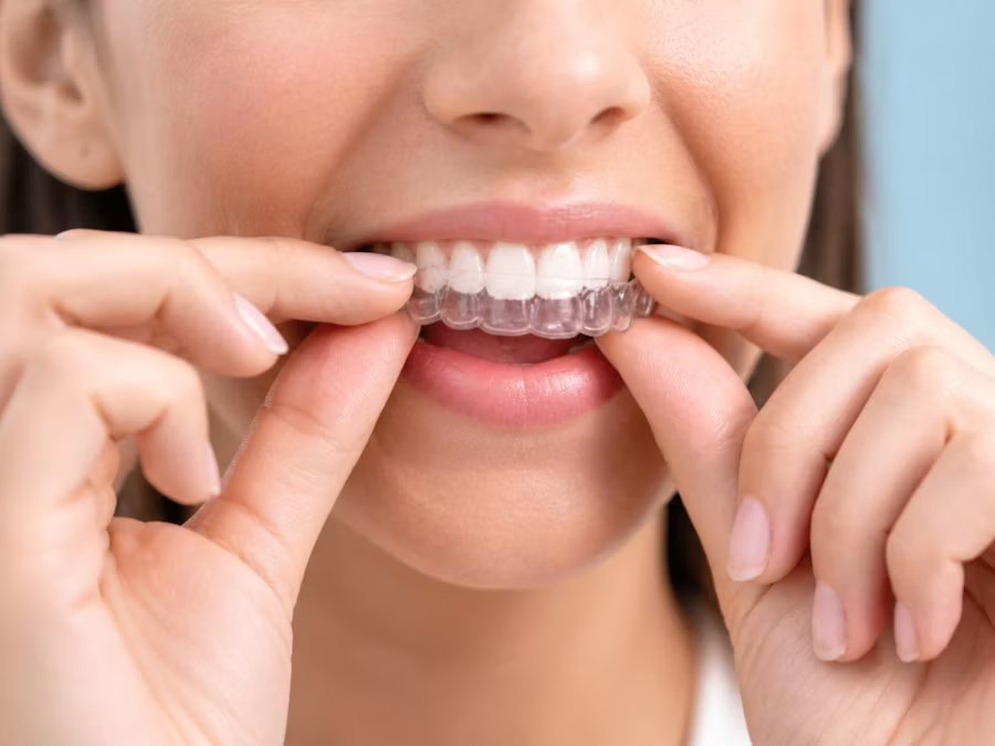 Clear aligners for teeth straightening