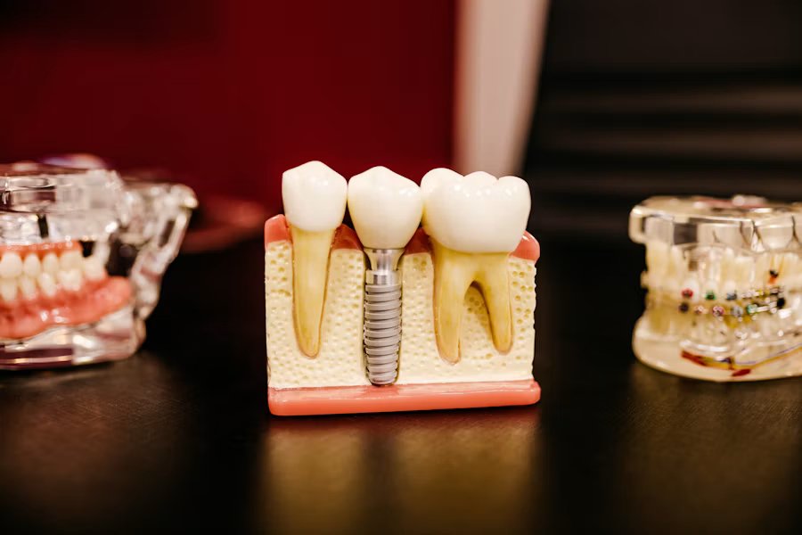 Dental implants at Ivory Dental