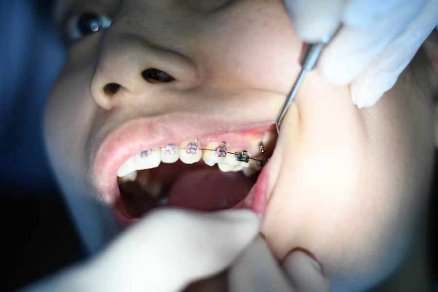 Orthodontics braces and aligners